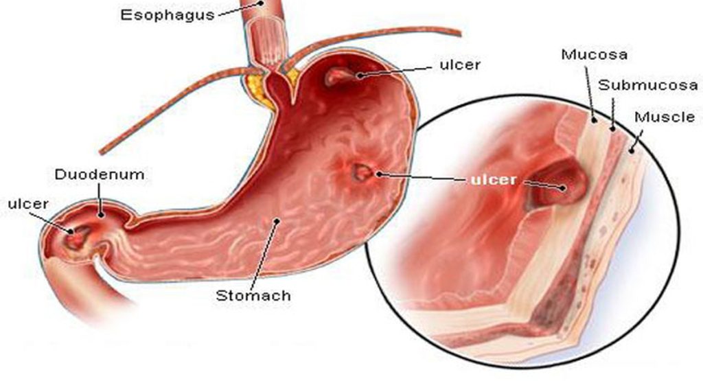 Understanding Ulcer Bleeding and Variceal Bleeding
